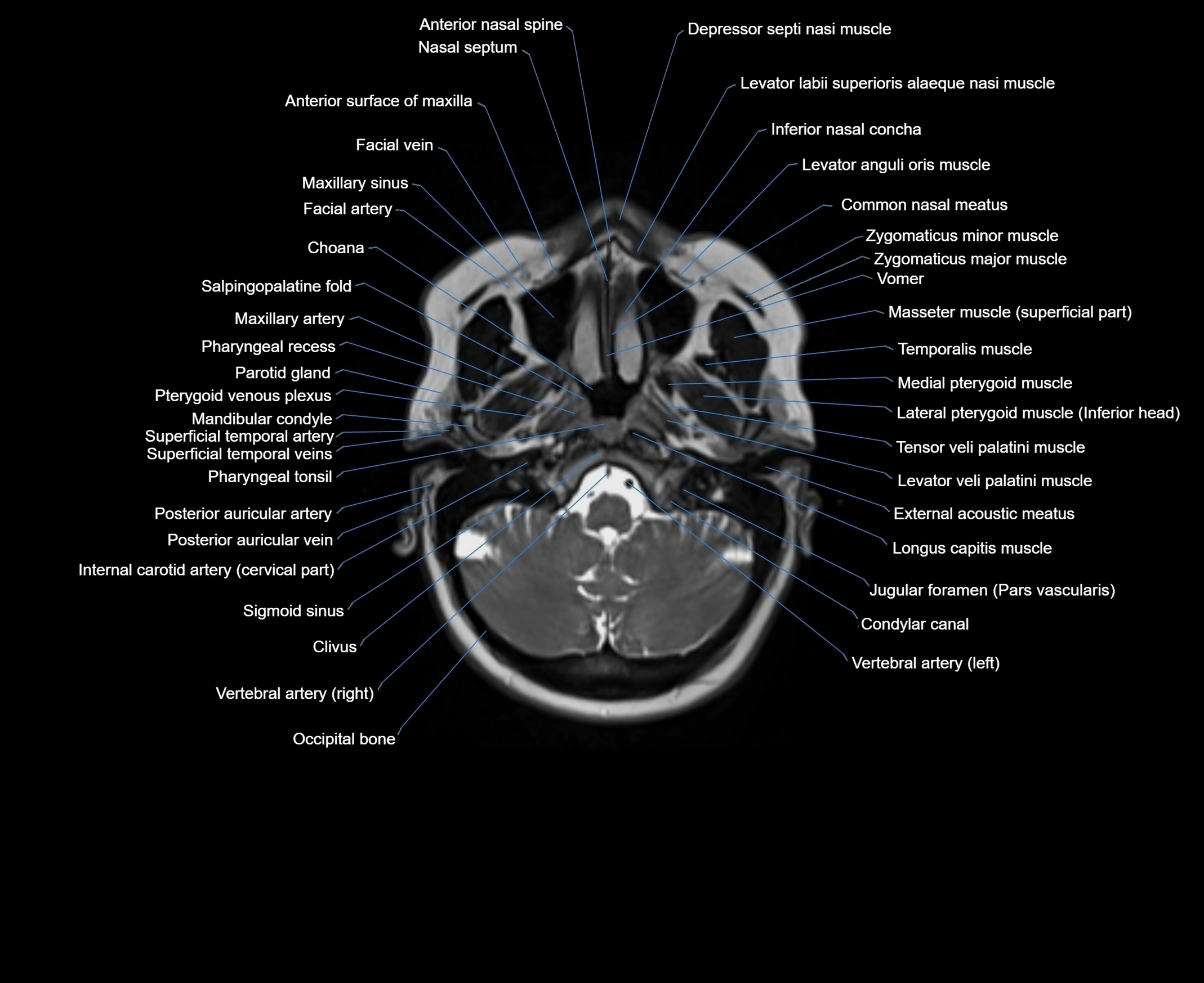 MRI Neck 3D labelled cross section anatomy axial 3t image-00001-00015.webp